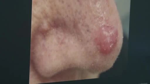 Basit Sanılan Bir Leke Cilt Kanseri Olabilir, Dermatolog Uyardı